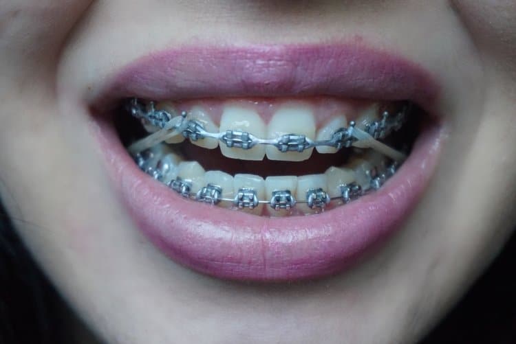 A close-up shot of a person's mouth with braces