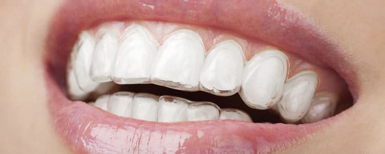A close-up shot of teeth with aligners